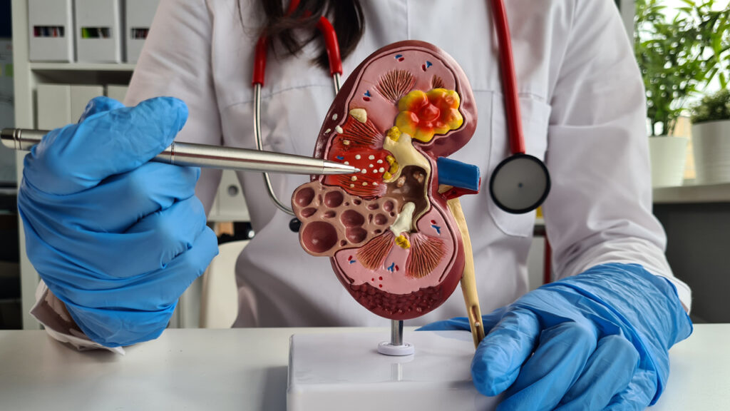 Chronic Renal Stones - Kidney Care Hospital